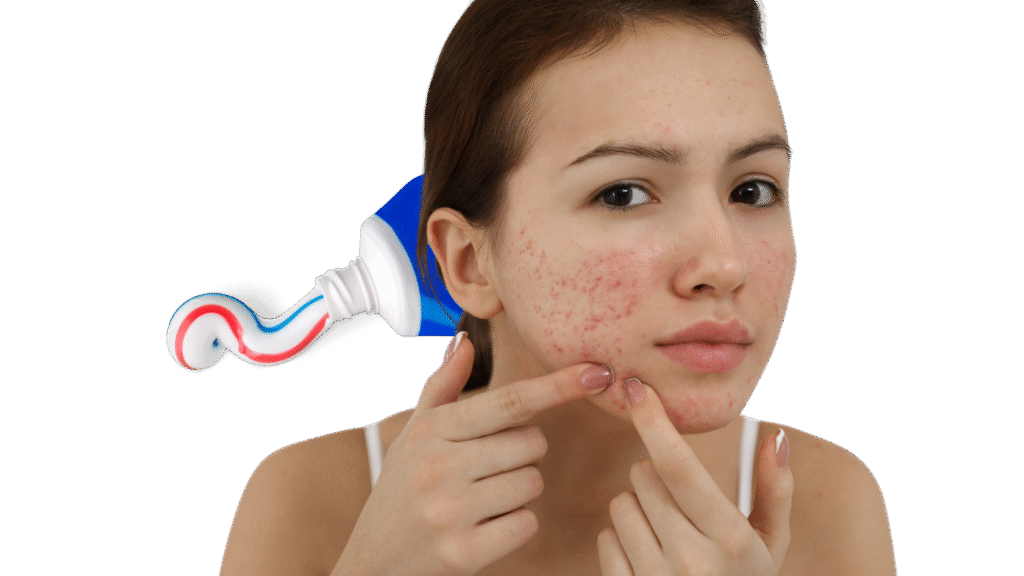 Toothpaste Zaps Pimples